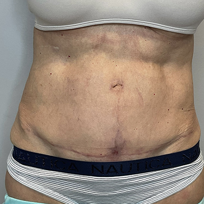 After Image: Tummy Tuck - front