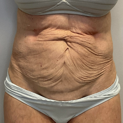 Before Image: Tummy Tuck - front