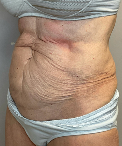 Before Image: Tummy Tuck - left-front-oblique
