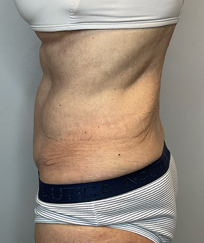 After Image: Tummy Tuck - left-side