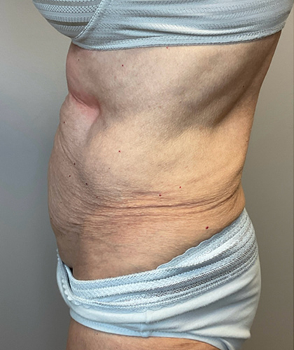 Before Image: Tummy Tuck - left-side