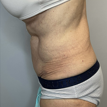 After Image: Tummy Tuck - left-side