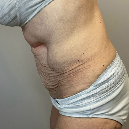 Before Image: Tummy Tuck - left-side