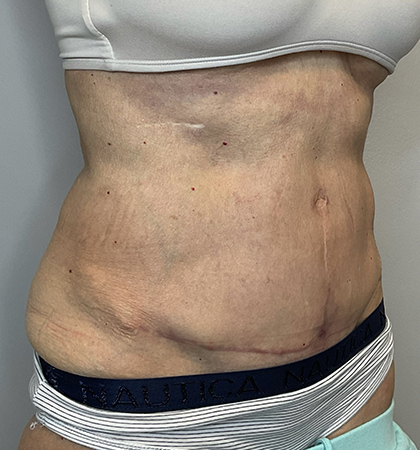 After Image: Tummy Tuck - right-front-oblique