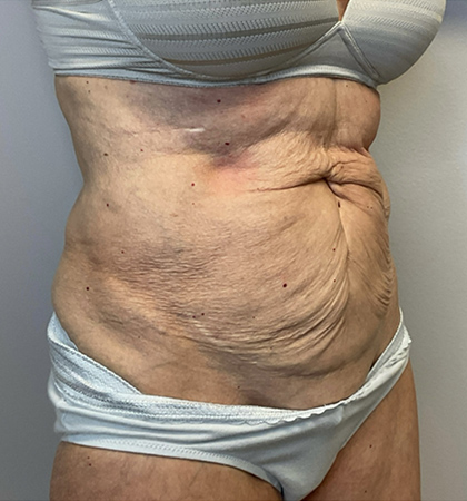 Before Image: Tummy Tuck - right-front-oblique