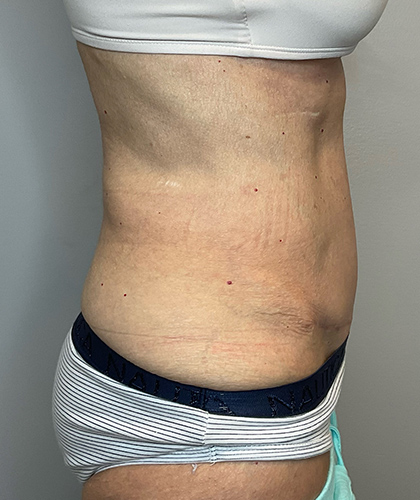 After Image: Tummy Tuck - right-side