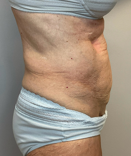 Before Image: Tummy Tuck - right-side