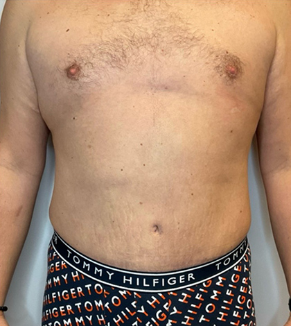 After Image: Liposuction, Tummy Tuck - front