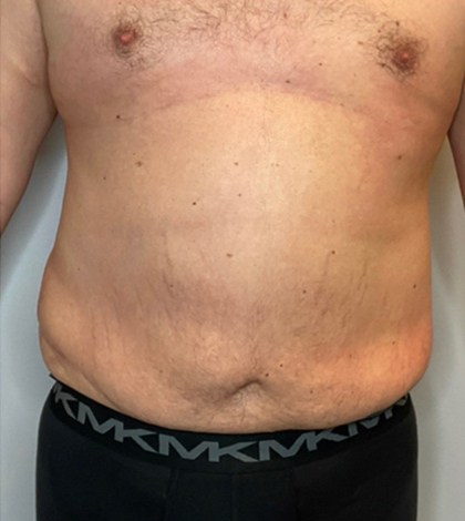 Before Image: Liposuction, Tummy Tuck - front