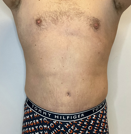 After Image: Liposuction, Tummy Tuck - front