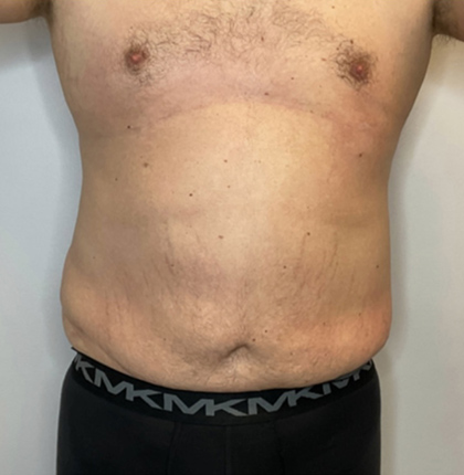 Before Image: Liposuction, Tummy Tuck - front