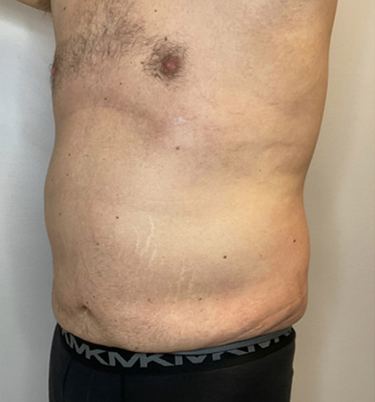 Before Image: Liposuction, Tummy Tuck - left-front-oblique