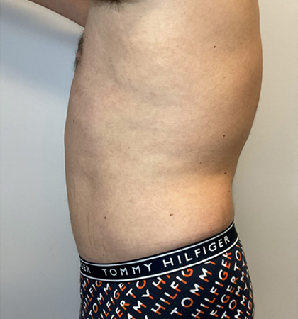 After Image: Liposuction, Tummy Tuck - left-side