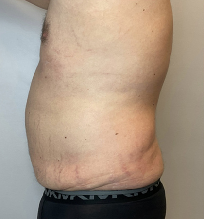 Before Image: Liposuction, Tummy Tuck - left-side