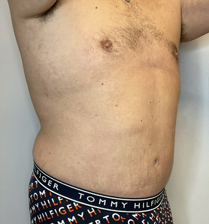 After Image: Liposuction, Tummy Tuck - right-front-oblique