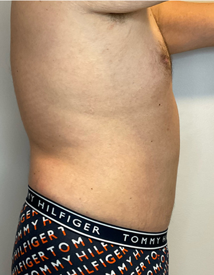 After Image: Liposuction, Tummy Tuck - right-side