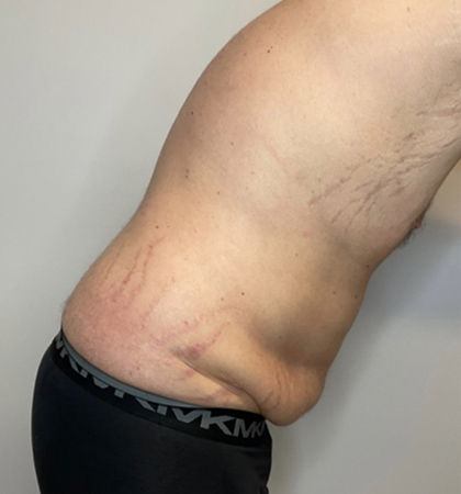 Before Image: Liposuction, Tummy Tuck - right-side