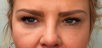 After Image: Blepharoplasty - front