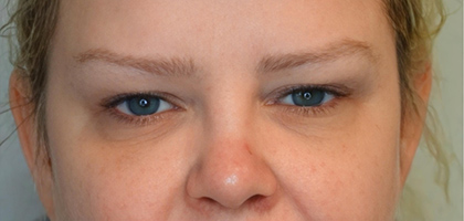 Before Image: Blepharoplasty - front
