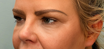 After Image: Blepharoplasty - left-front-oblique