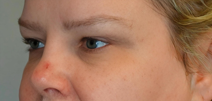 Before Image: Blepharoplasty - left-front-oblique