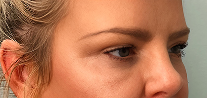 After Image: Blepharoplasty - right-front-oblique