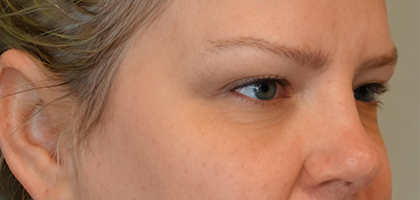 Before Image: Blepharoplasty - right-front-oblique