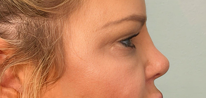 After Image: Blepharoplasty - right-side