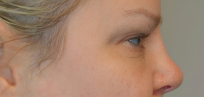 Before Image: Blepharoplasty - right-side