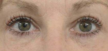 After Image: Blepharoplasty - front