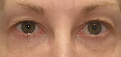Before Image: Blepharoplasty - front