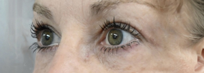 After Image: Blepharoplasty - left-front-oblique
