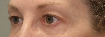 Before Image: Blepharoplasty - left-front-oblique