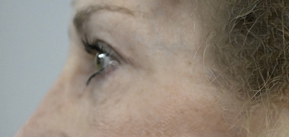 After Image: Blepharoplasty - left-side