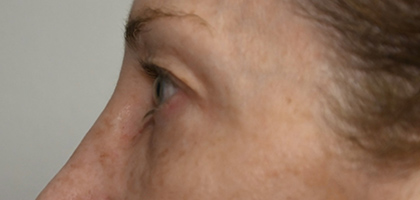 Before Image: Blepharoplasty - left-side