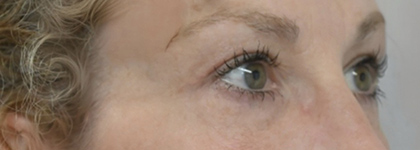 After Image: Blepharoplasty - right-front-oblique
