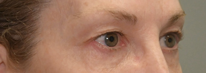 Before Image: Blepharoplasty - right-front-oblique