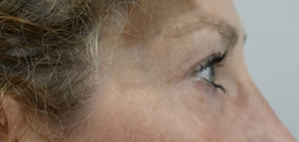 After Image: Blepharoplasty - right-side