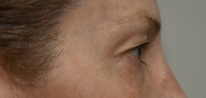 Before Image: Blepharoplasty - right-side
