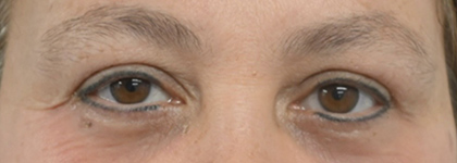 After Image: Blepharoplasty - front