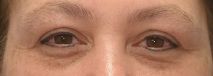 Before Image: Blepharoplasty - front