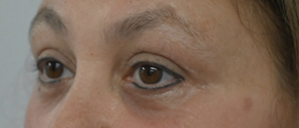After Image: Blepharoplasty - left-front-oblique