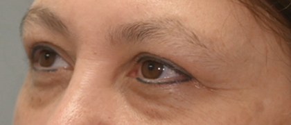 Before Image: Blepharoplasty - left-front-oblique