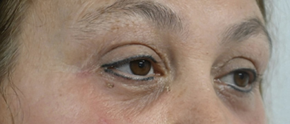 After Image: Blepharoplasty - right-front-oblique