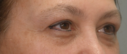 Before Image: Blepharoplasty - right-front-oblique