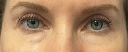 After Image: Blepharoplasty - front