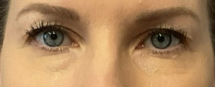 Before Image: Blepharoplasty - front
