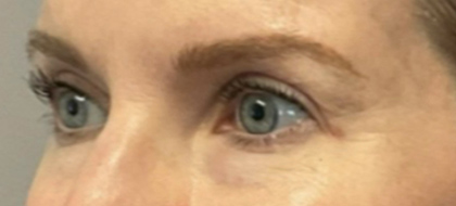 After Image: Blepharoplasty - left-front-oblique