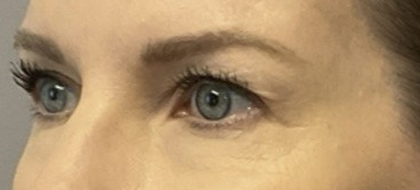 Before Image: Blepharoplasty - left-front-oblique