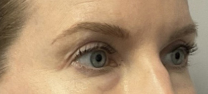 After Image: Blepharoplasty - right-front-oblique